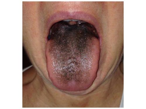 What can happen if you take too much Pepto-Bismol (see diarrhea map)